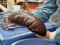 Dalak Tümörleri Malign Tümörler