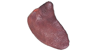 Dalak Kisti Belirtileri ve Tedavisi